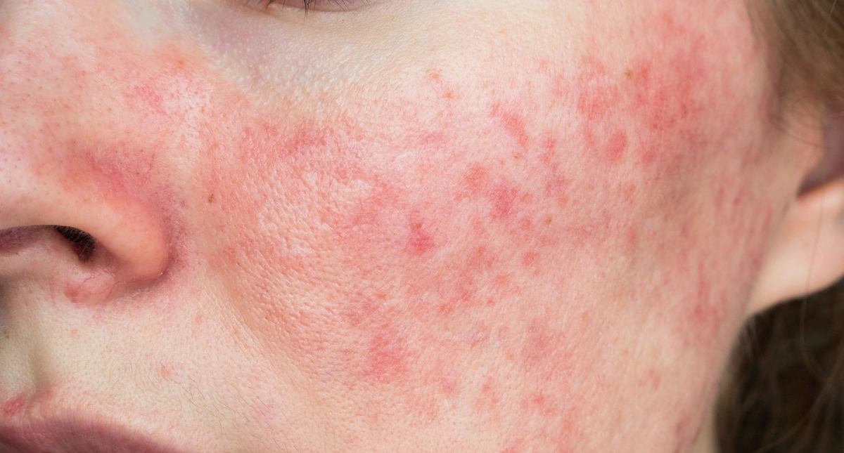 Rosacea Hautpflege