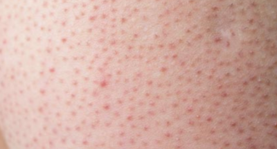 Reibeisenhaut Keratosis Pilaris