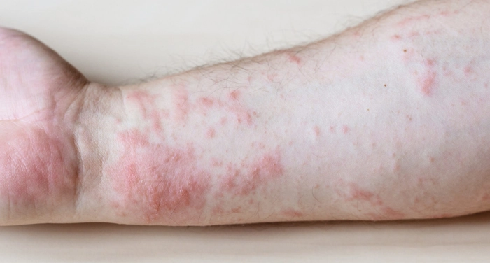 Kontaktdermatitis