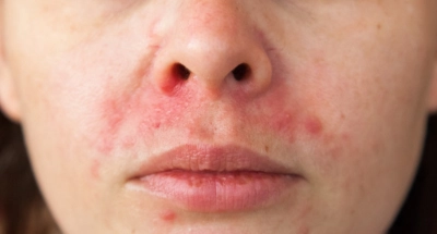 Periorale Dermatitis Mundrose