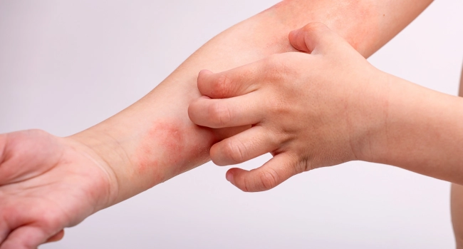 Dermatitis Hauterkrankungen Übersicht